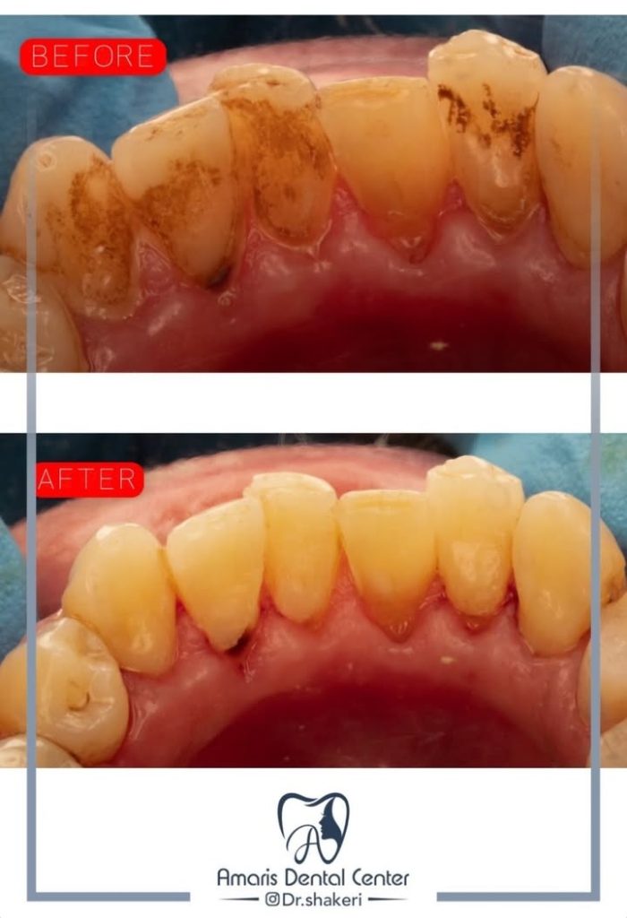 قبل و بعد جرمگیری دندان